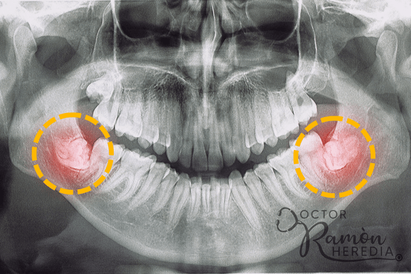 radiografía de extracción de cordales