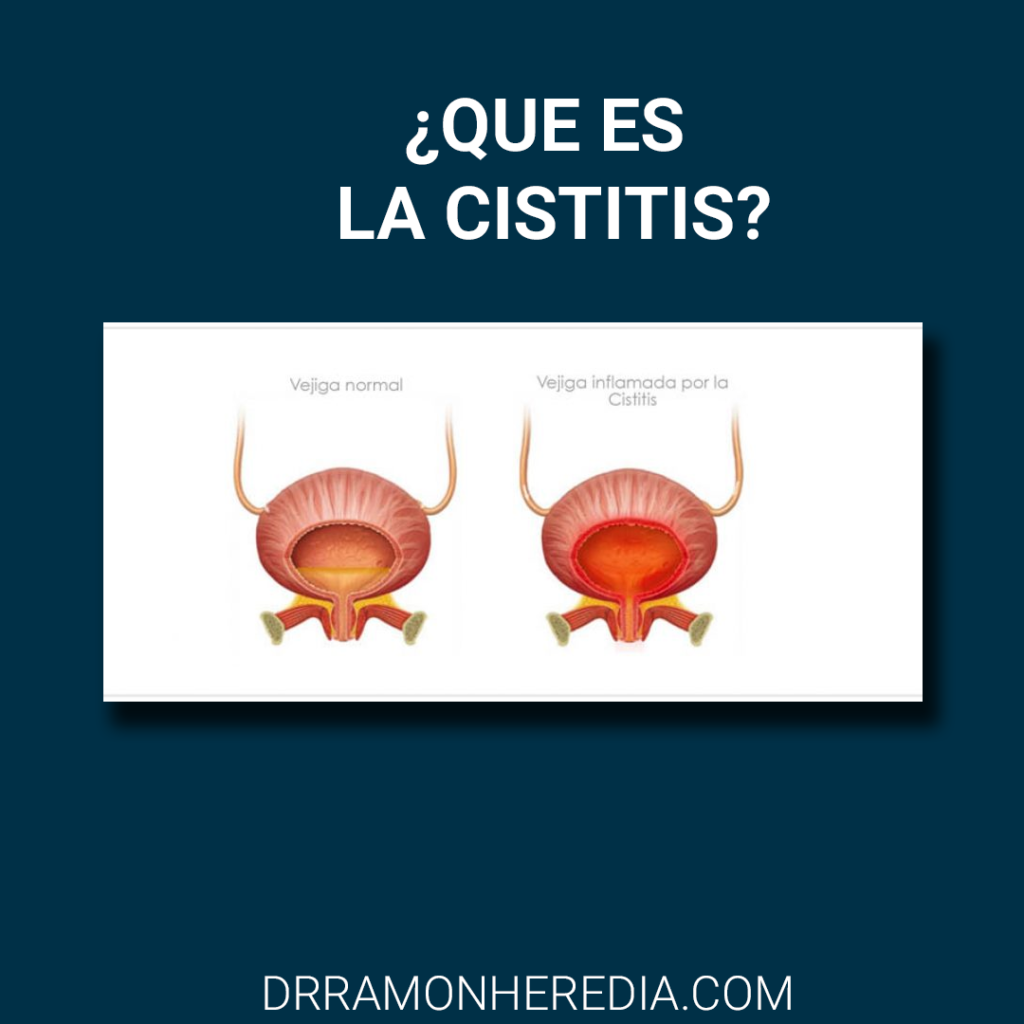 que es la cistiti