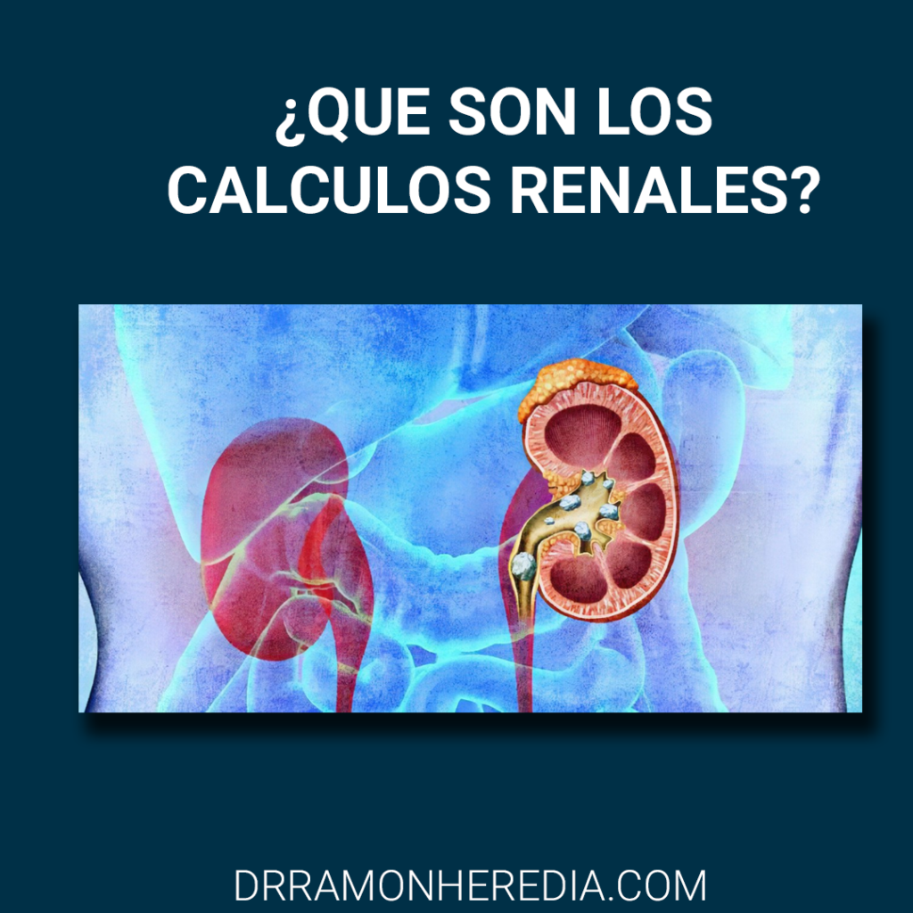 calculos renales