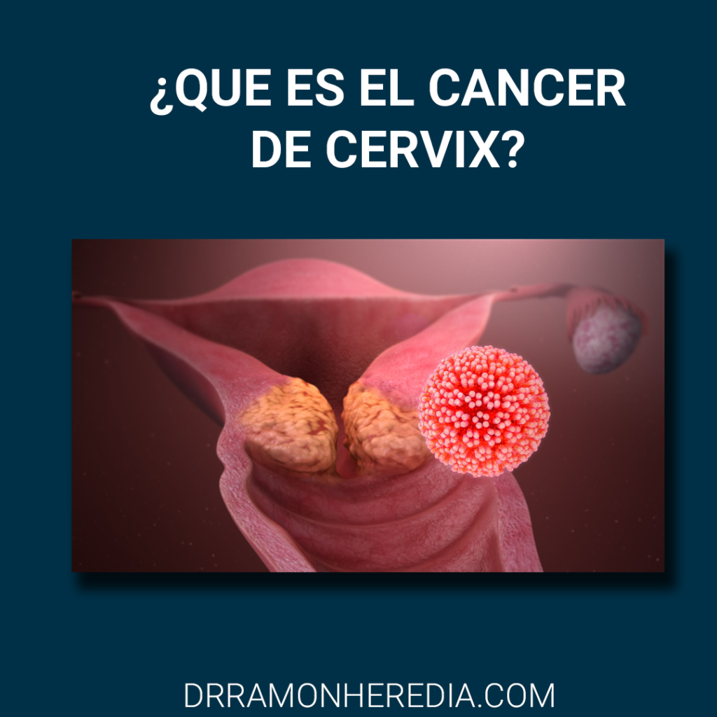 cancer de cervix