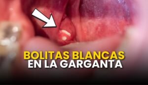 bolita blancas en la garganta